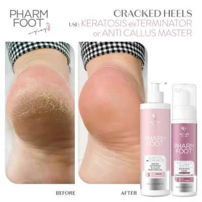Pharm Foot - Anti Callus Master - 200ml - Krämer -glamandbeauty.se Pharm Foot - Anti Callus Master - 200ml - Krämer -glamandbeauty.se