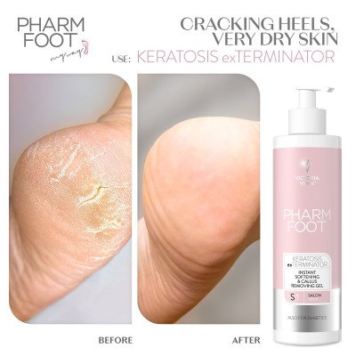 Pharm Foot - All in - Keratosis Exterminator - 300 ml - Krämer -glamandbeauty.se